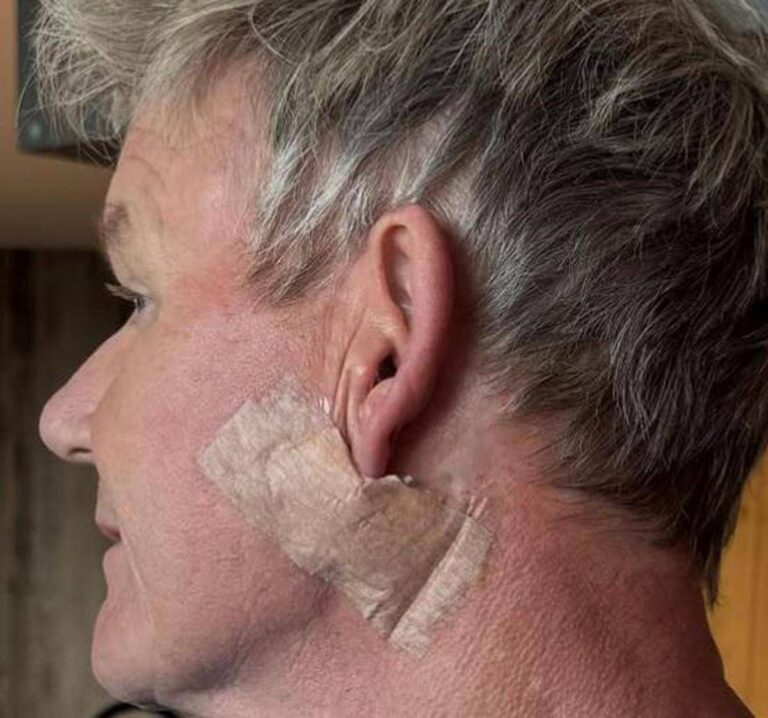 Gordon Ramsay: “Operato per tumore della pelle”
