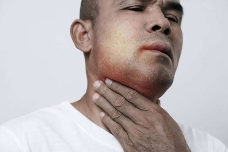 Angioedema ereditario, ok Ue a prima terapia preventiva mirata all’Rna