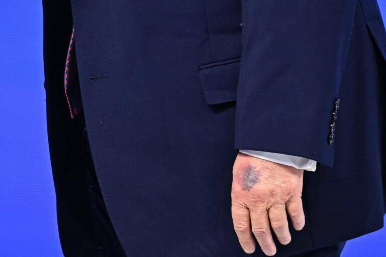 Trump e il nuovo livido sulla mano, tutte le ipotesi secondo Bassetti